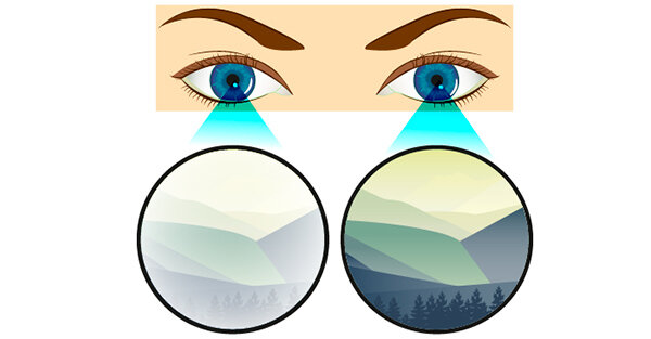Что такое гетерохромия, как она выглядит и почему появляется разный цвет глаз