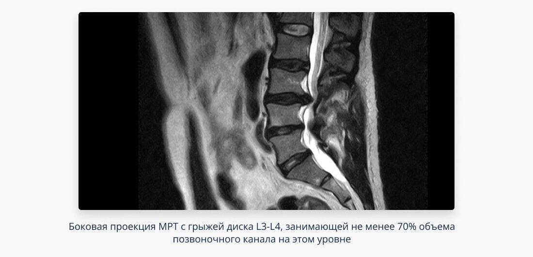 Грыжа межпозвоночного диска: причины, симптомы и лечение