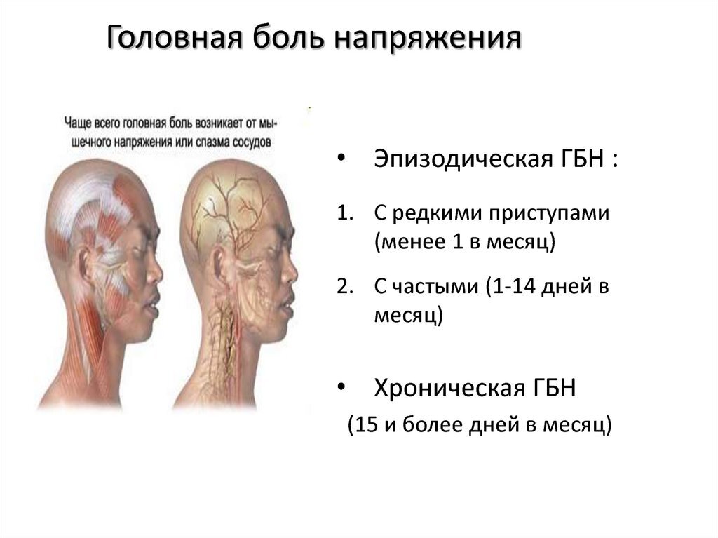 Головные боли напряжения схема