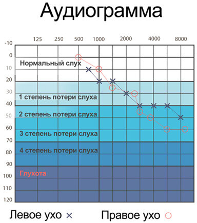 Типичная аудиограмма