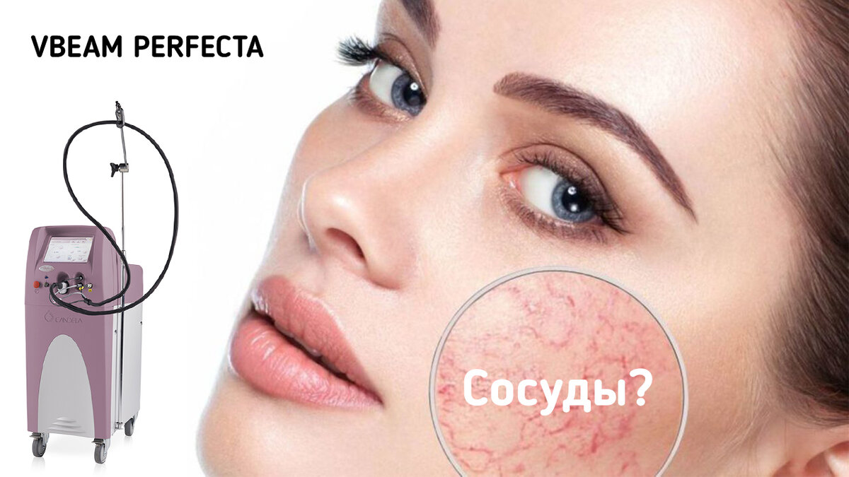 Лазер Vbeam Perfecta против сосудистых дисхромий