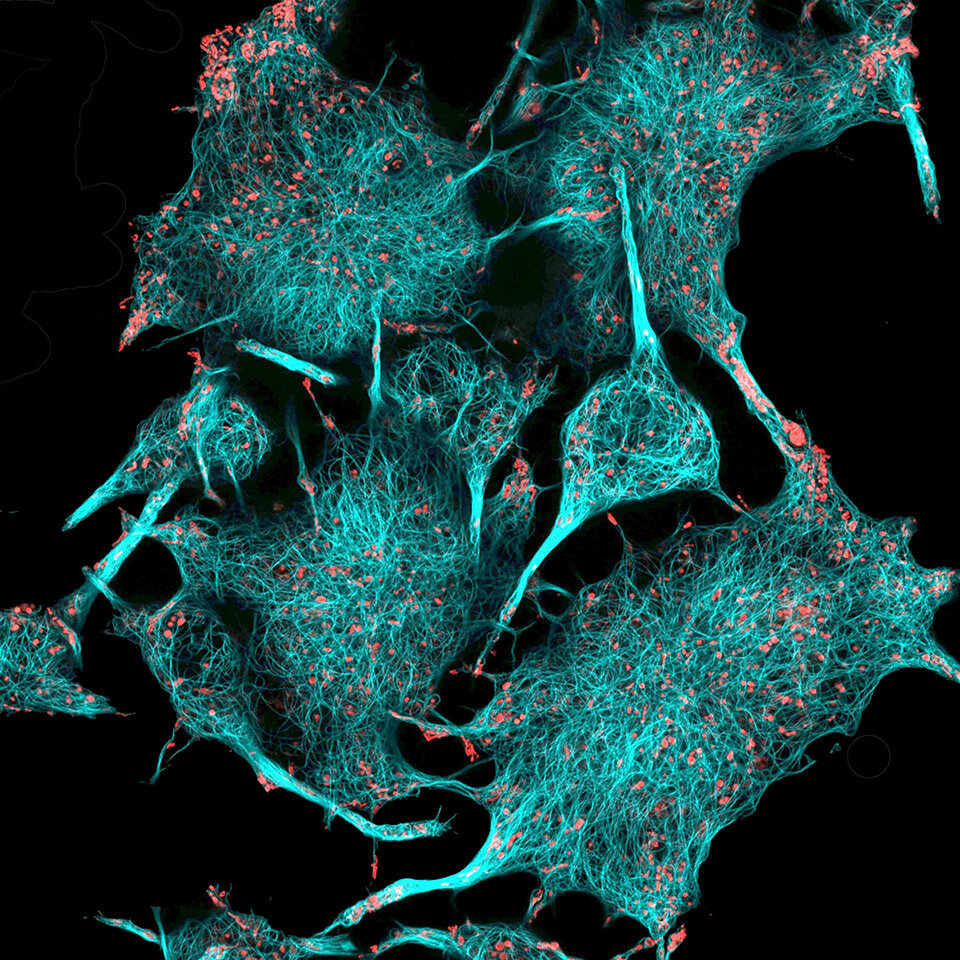 Клетки раковой опухоли в мозге мыши (голубым цветом окрашены микротрубочки, красным — митохондрии)

Dr. Sharada Tilve