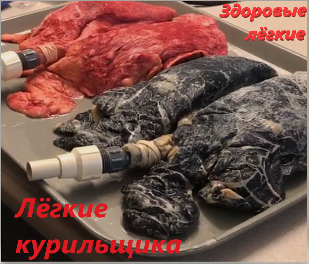 Поразительная разница между здоровыми и поражёнными лёгкими.