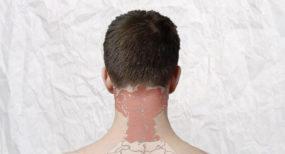 Спазм мышц шейного отдела позвоночника 