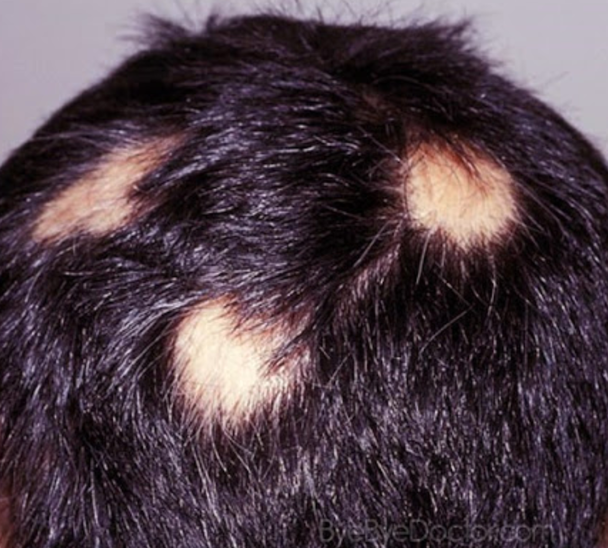 Очаговая алопеция (alopecia Areata). Гнездная алопеция офиазис.