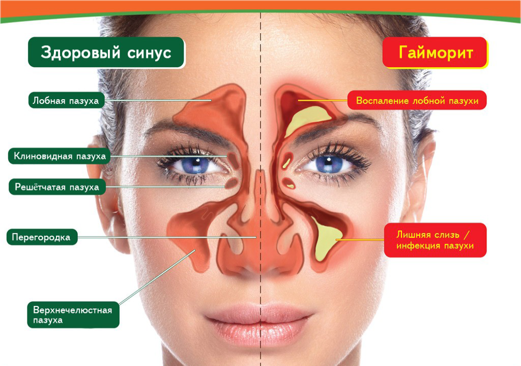 Все симптомы, указывающие на то, что у вас гайморит, а не простуда