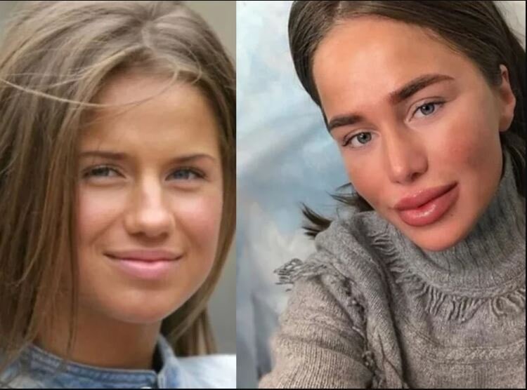 Алекса певица фото до и после пластики