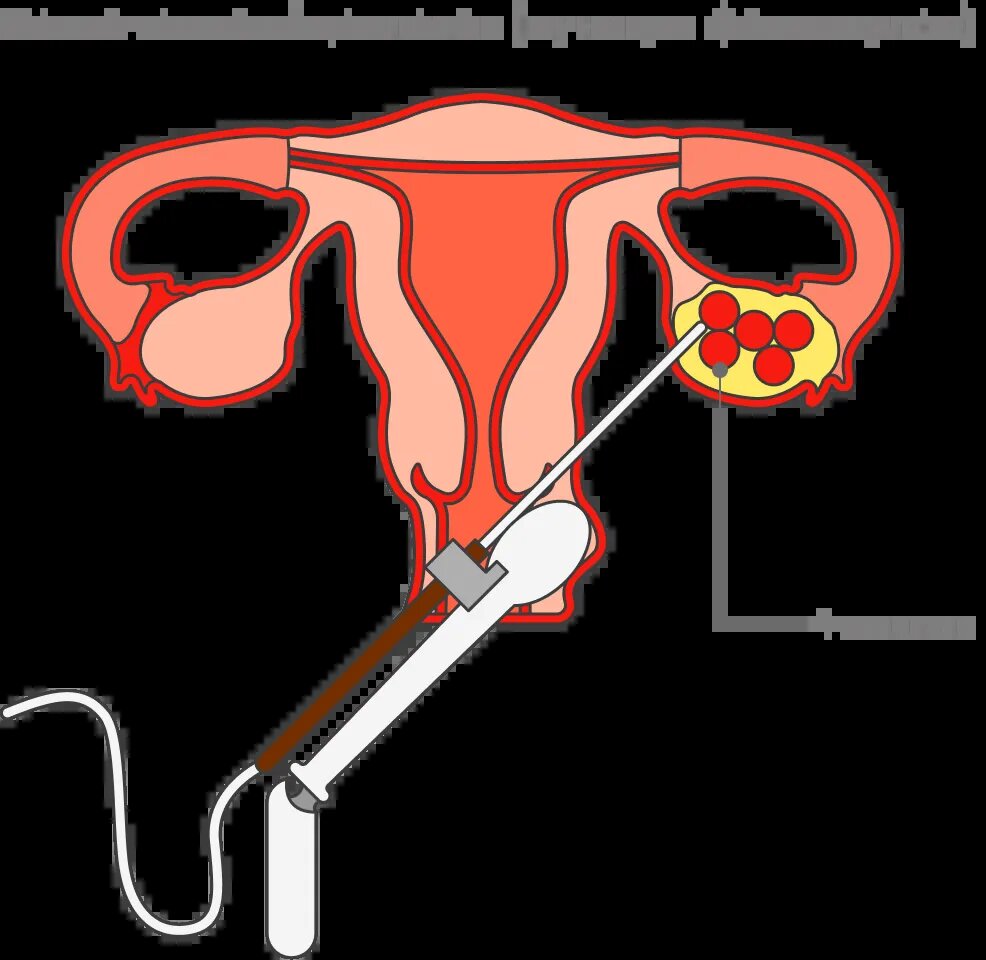 Руководство по пункции фолликулов. Good practice ESHRE. Часть 1. | Басова  Алена Игоревна IVF | Дзен