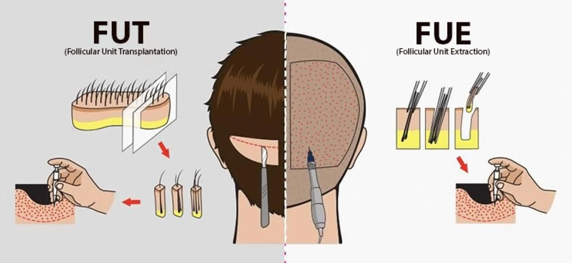 Волос методом. Пересадка волос схема. FUT трансплантация волос что это такое.