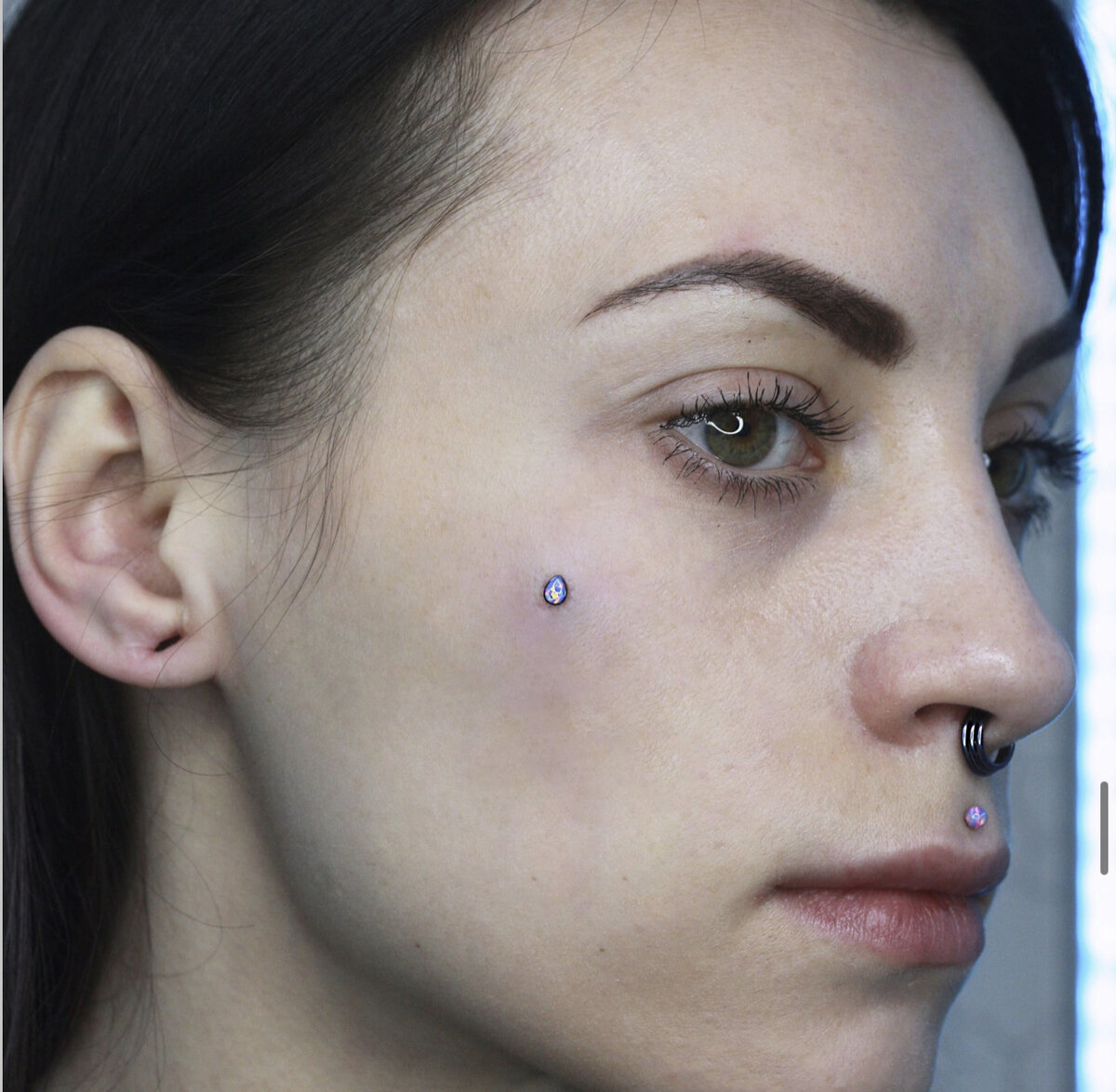 Фото микродермала сразу после установки.