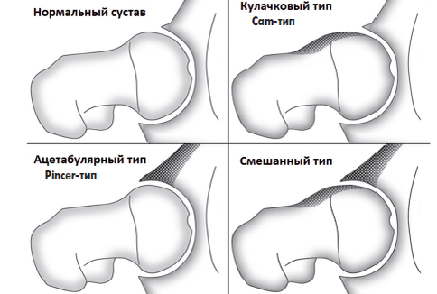 Щелкает тазобедренный сустав?