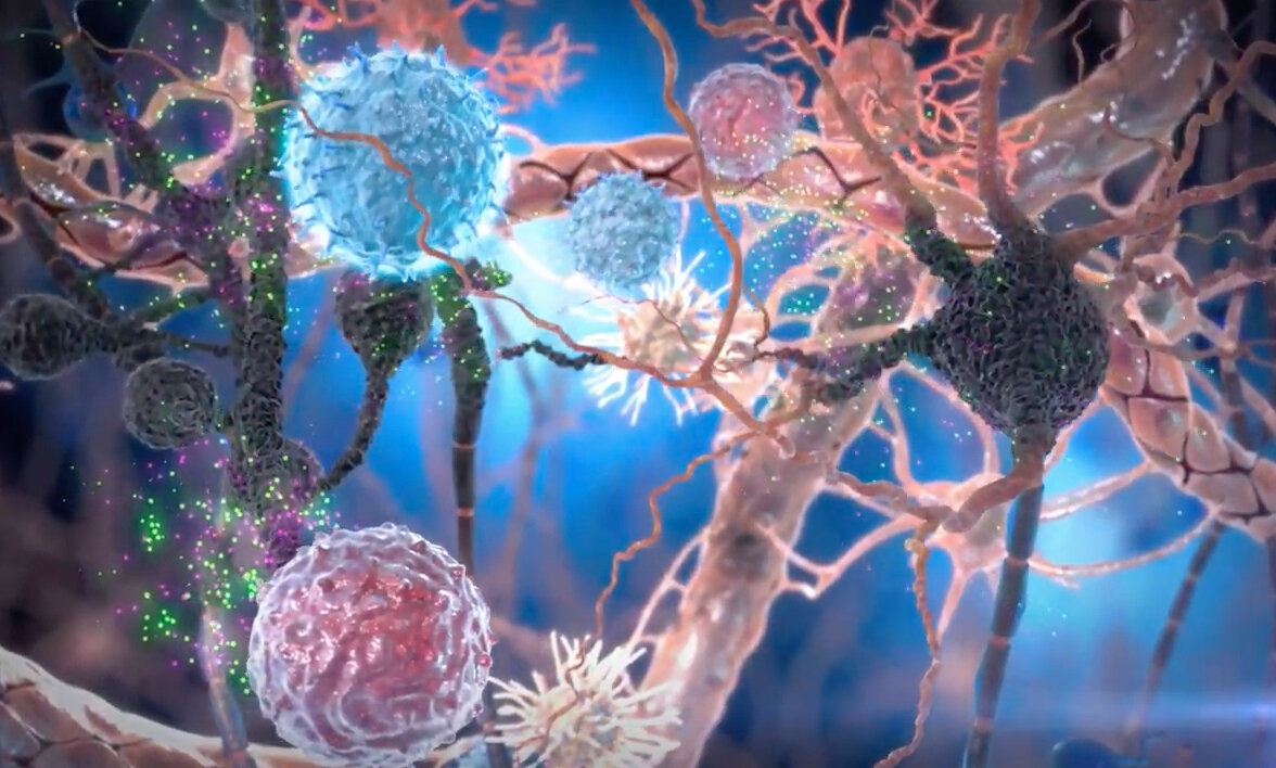 новое рассеянный склероз 2023