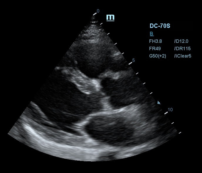 Снимок УЗИ аппарата Mindray DC-70s c использованием технологии iClear