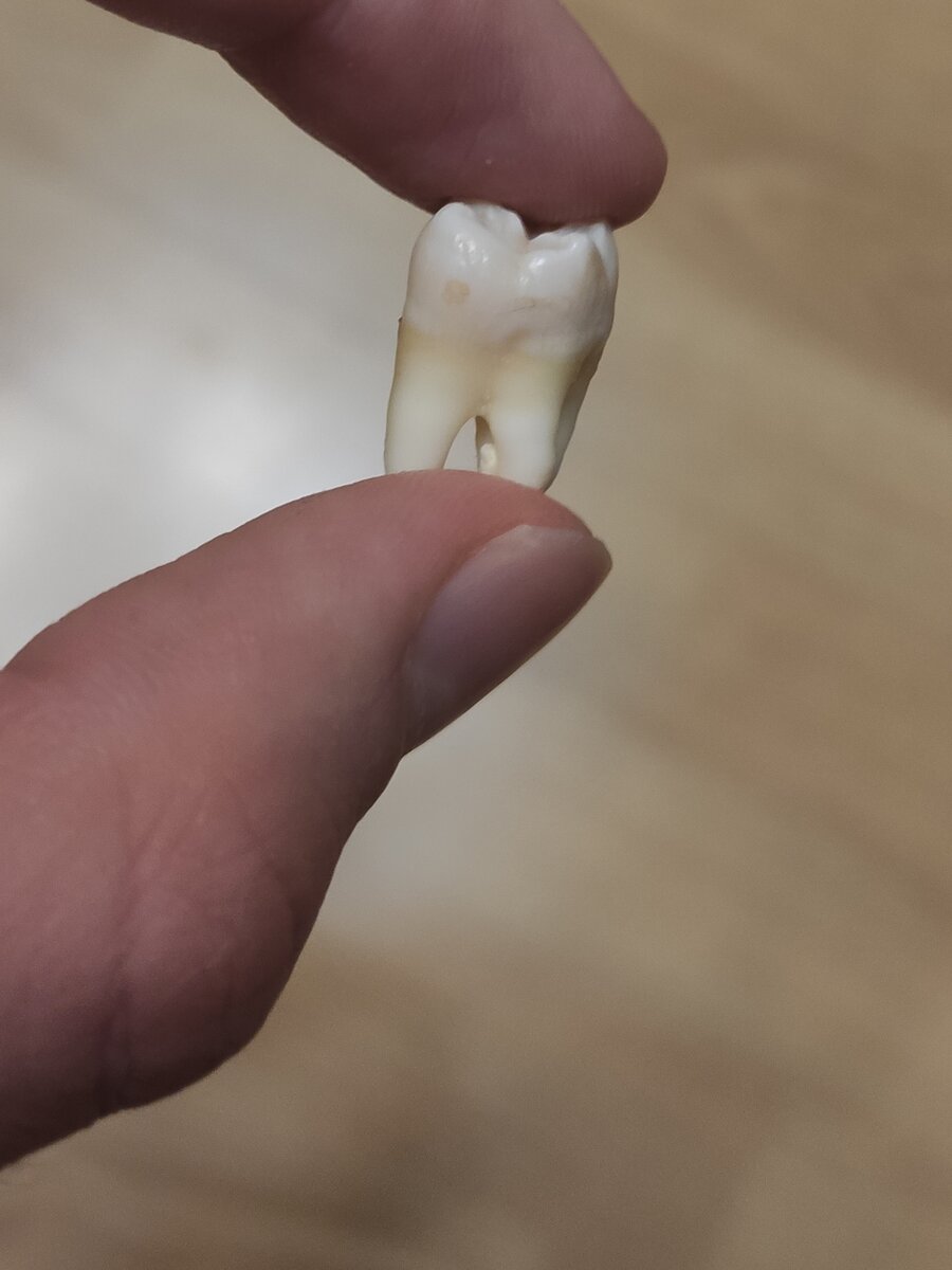 осложнения после удаления зуба фото