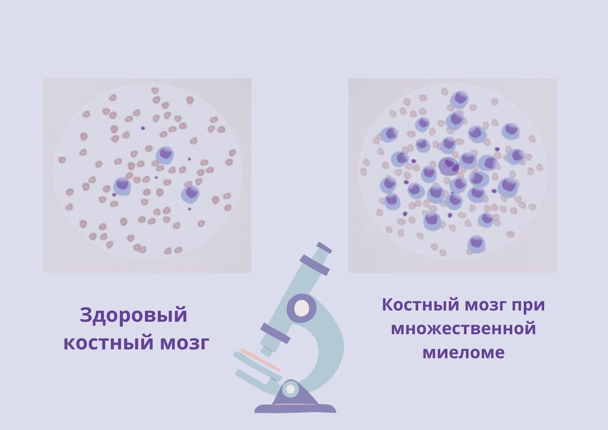 Профилактика онкология миелома. Схема СVD множемственная миелома.