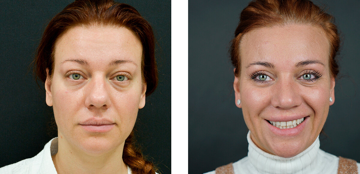 Анатомически обусловленные грыжи нижнего века и нависание верхнего века. Проведена верхняя и нижняя трансконъюнктивальная блефаропалстика. 