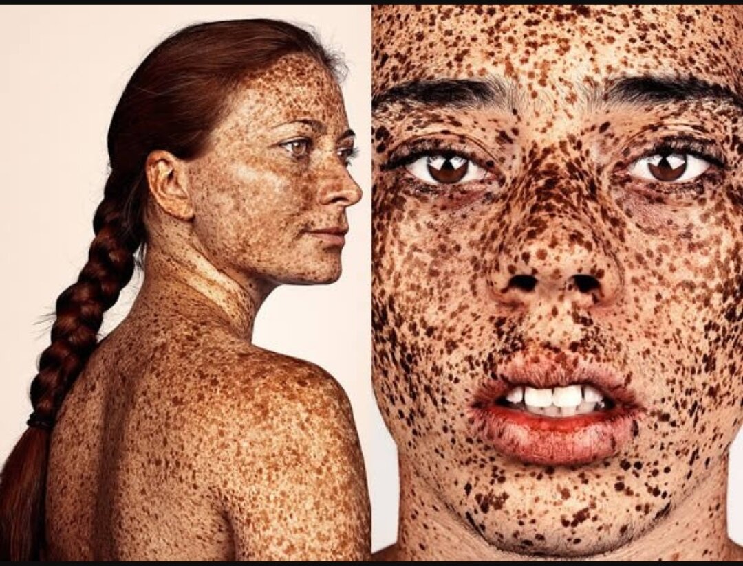 Фотограф Брок Элбанк — ещё один художник, который хочет показать, насколько на самом деле красивы веснушки. Он начал проект, посвящённый фотографированию людей с веснушками, в 2012 году в полупустой студии, чтобы ничто не отвлекало внимания от героев его снимков. В центре внимания — только веснушки.