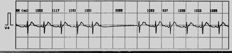 Синусно-предсердная блокада, которую я нашел у своего пациента на холтеровском мониторе. Хорошо видно, что на фоне ритма сердца с интервалами между ударами чуть больше секунды (время в миллисекундах) вдруг появляется пауза, которая в 3 раза превышает остальные интервалы. Длительность паузы 3 секунды. Таких пауз было много. 