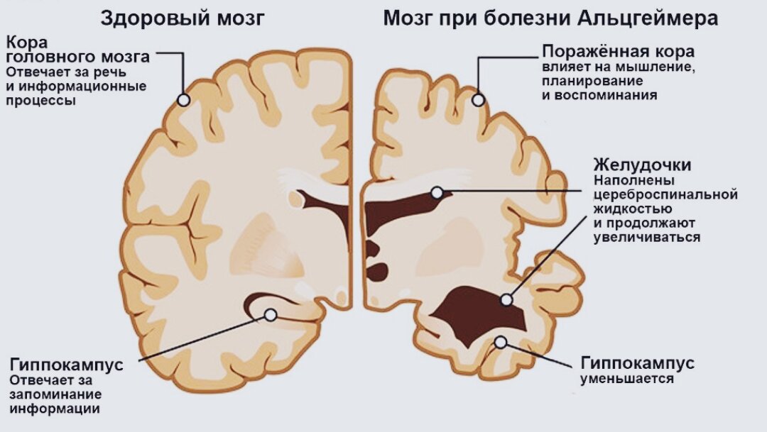 Изменения в мозге. Болезнь Альцгеймера очаг поражения. Синдром Альцгеймера мозг. Головной мозг при болезни Альцгеймера.