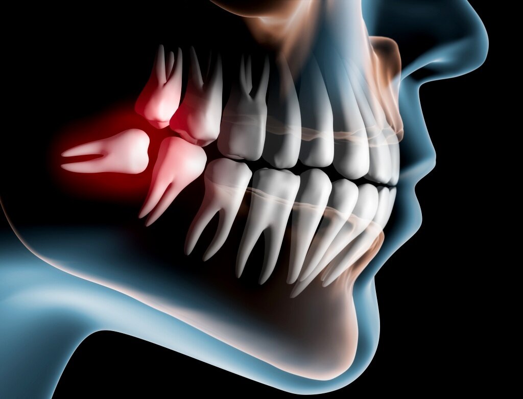 Что делать, если зуб мудрости растёт горизонтально