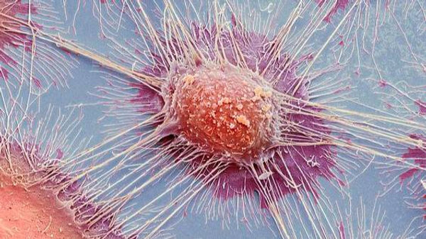 Клетки плоскоклеточного рака изо рта. Изображение © Flickr / Weining Zhong