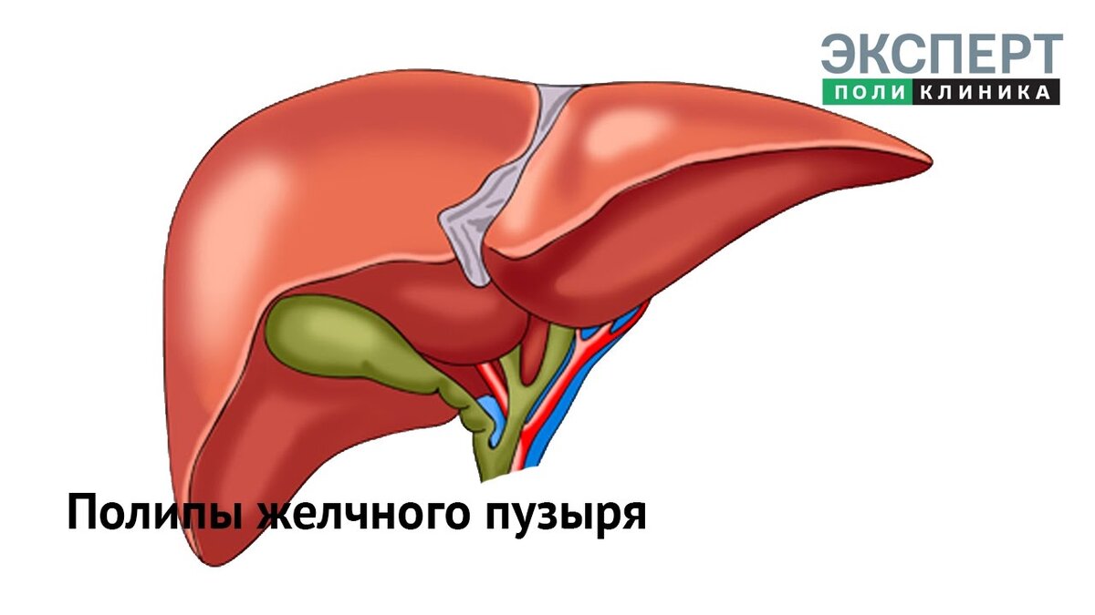 Полипы желчного пузыря | Клиника ЭКСПЕРТ - Гастро-гепатоцентр | Дзен