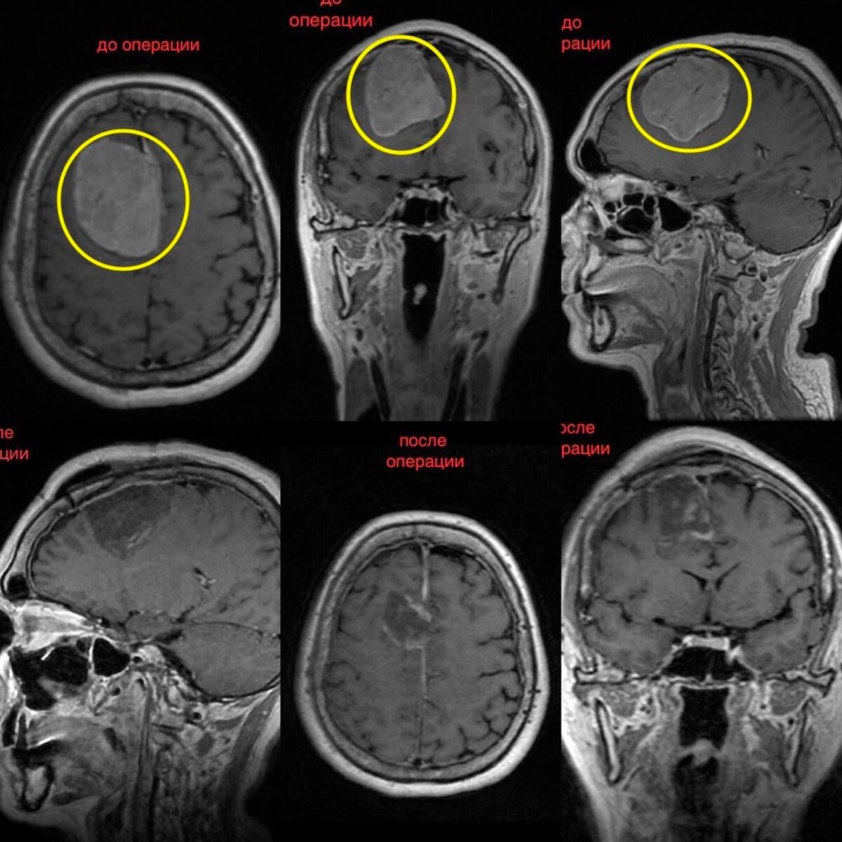 Менингиома головного мозга операция отзывы. Менингиома кавернозного синуса. Менингиома твердой мозговой оболочки. Менингиома средней черепной ямки справа.