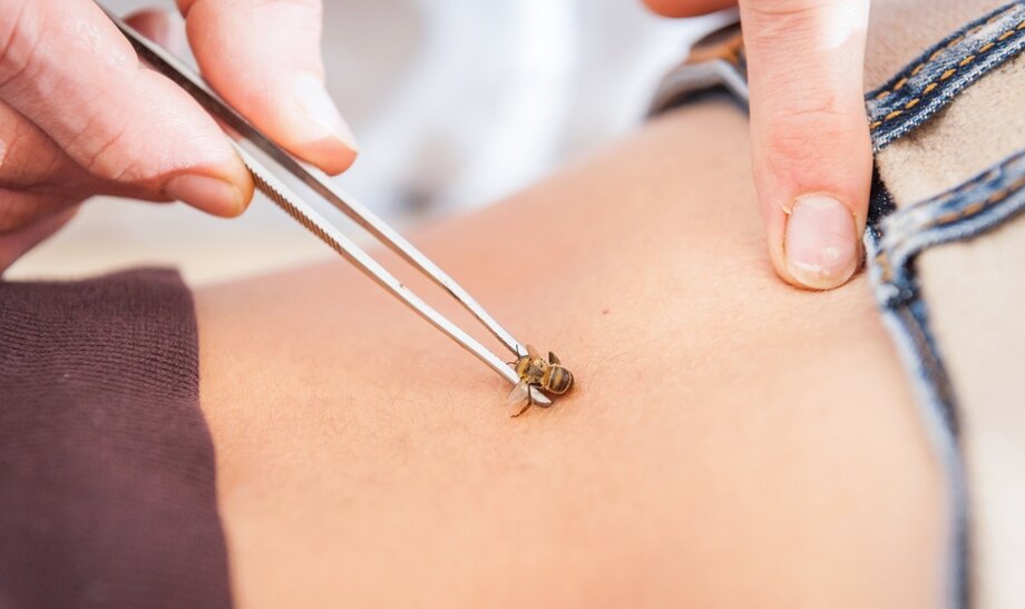 Один из методов апитерапии - пчелоужаление