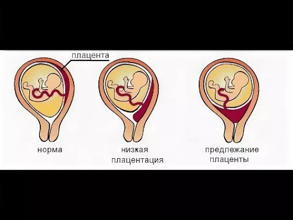 Низкое расположение плаценты