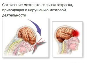 Сотрясение головного мозга - диагностика и лечение в Москве. Консультация врача.