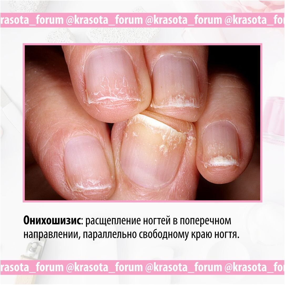 Заболевания ногтей. Онихолизис. Онихорексис. Онихошизис. | Блог Хорошего  Мастера | Дзен