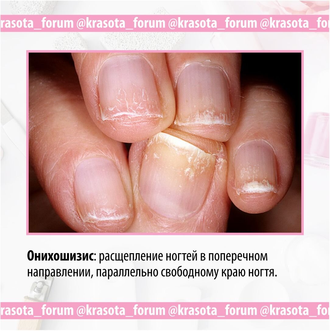 Заболевание определить по ногтям рук фото Заболевания ногтей. Онихолизис. Онихорексис. Онихошизис. Блог Хорошего Мастера Д