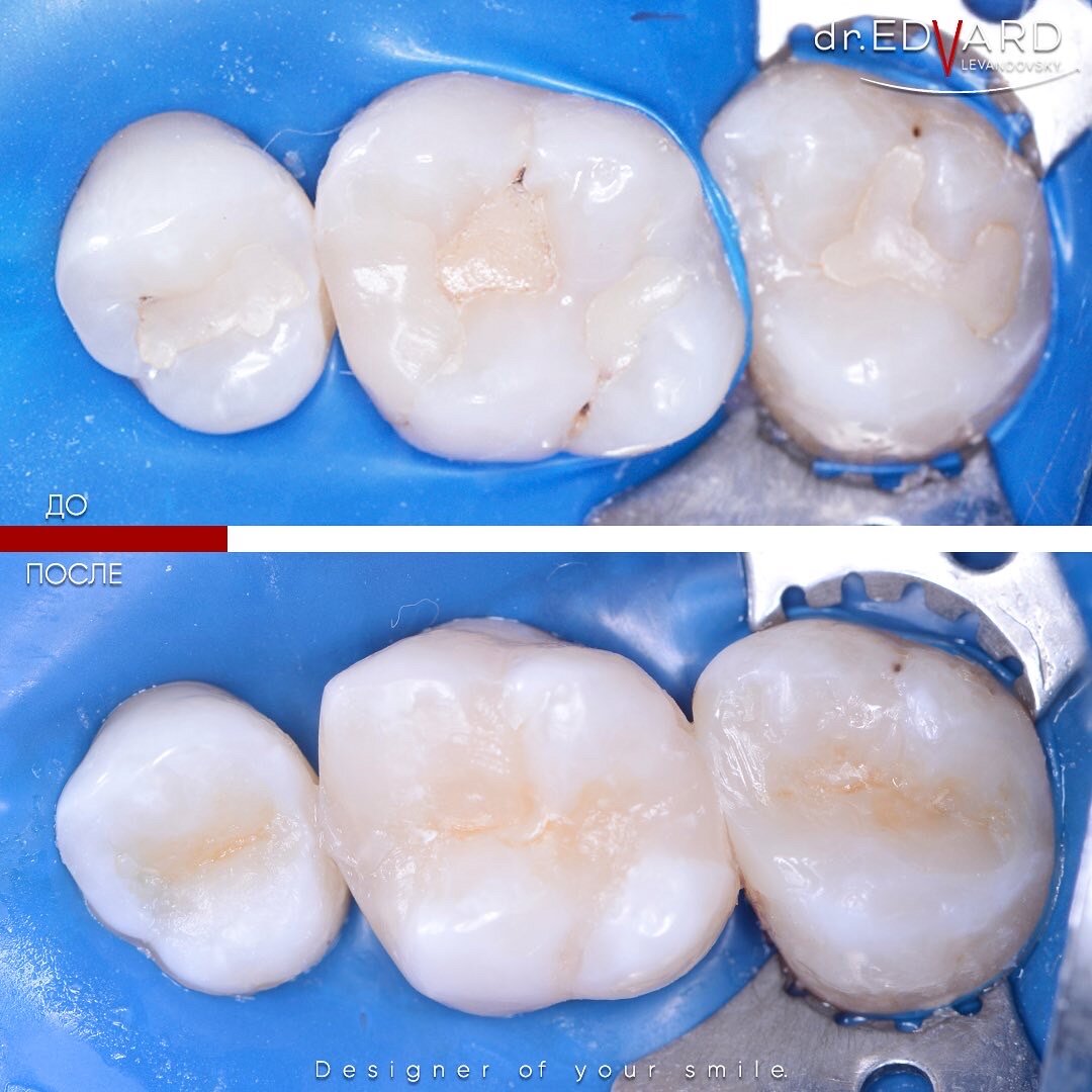 Лечение кариес