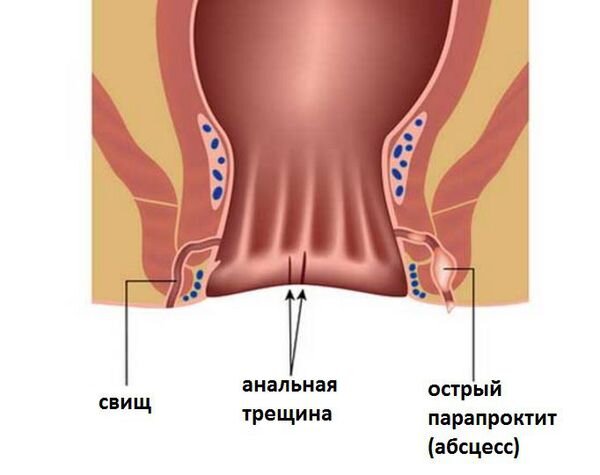 Трещина заднего прохода: симптомы, причины и лечение