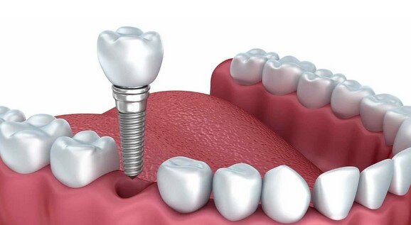 Через какое время после удаления зуба можно ставить имплант ...