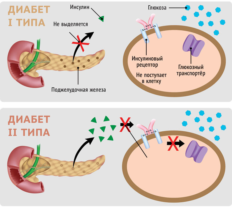 Сахарный диабет 2 типа картинки для презентации