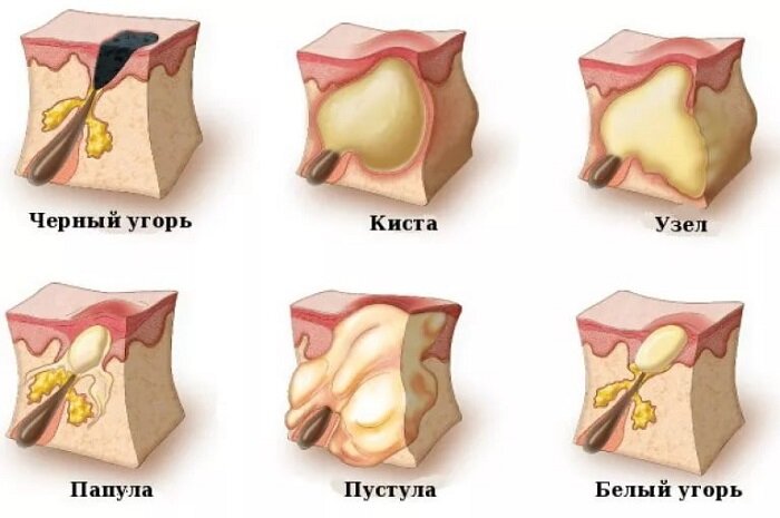 Какими симптомами проявляются кисты пазухи носа?