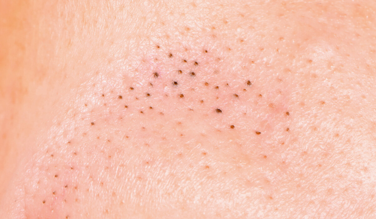 черные точки