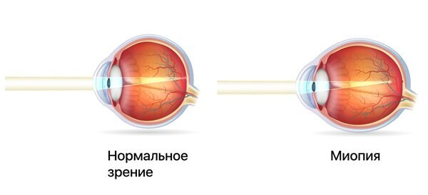 Изменение формы глазного яблока при миопии