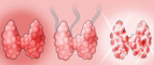 Радиойодтерапия