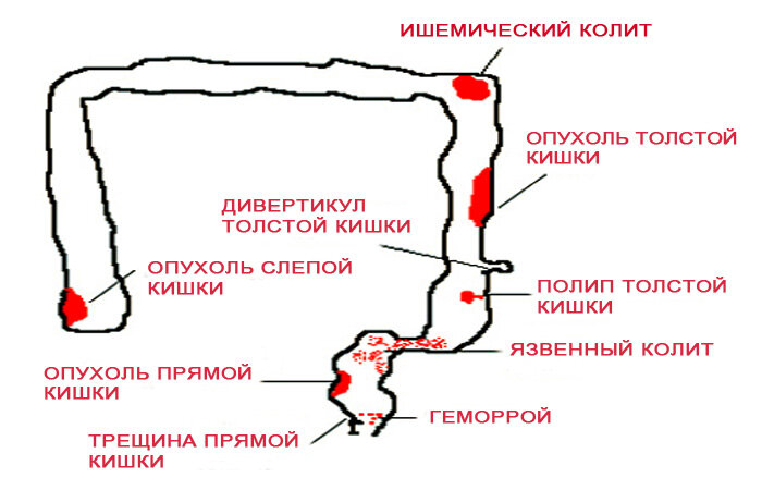 Причины появления крови со стулом.