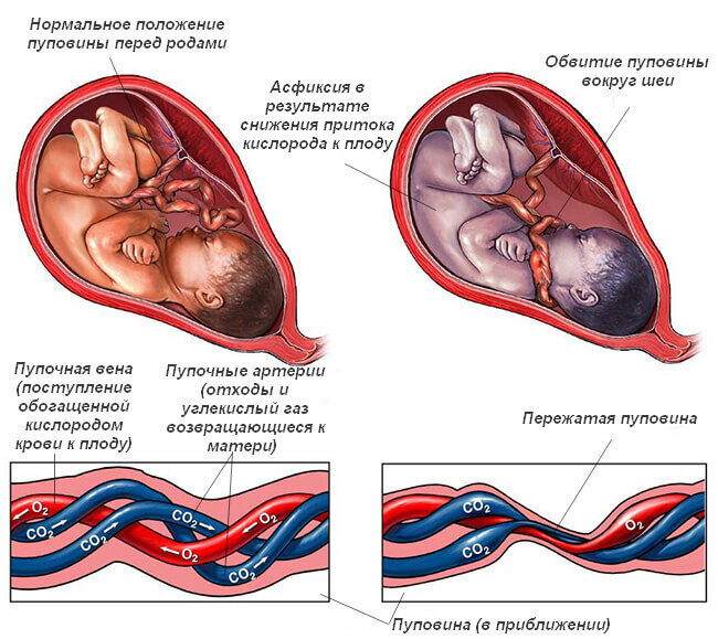 Обвитие пуповиной при беременности — причины, диагностика и риски.