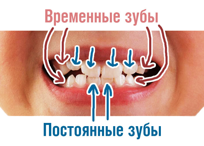 Временные зубы и постоянные зубы в сменном прикусе у ребёнка.