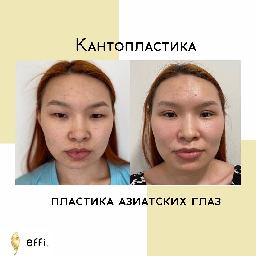 Кантопексия фото до и после операции Блефаропластика азиатских век в Красноярске Клиника косметологии и пластической 
