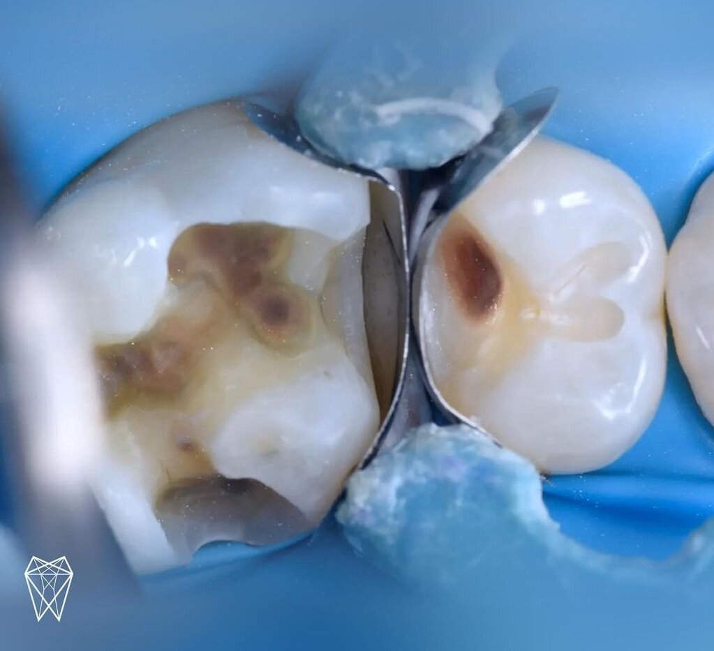 Случай из практики: пломба-терминатор | Стоматология Belgravia Dental ...