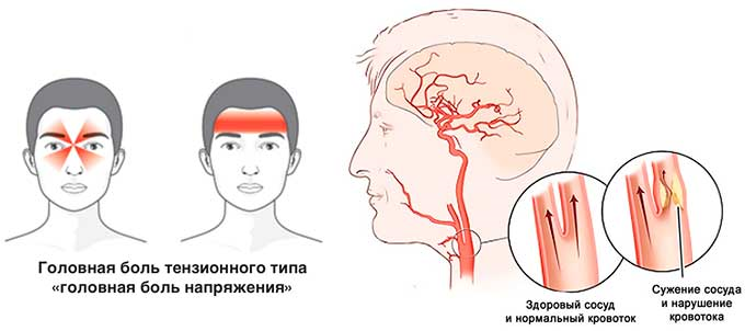 Болит голова спазм