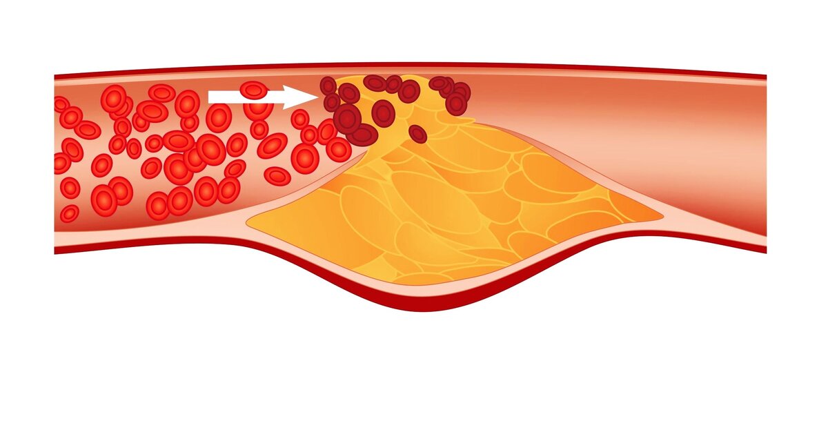 Бляшки в сосудах. Отрыв атеросклеротической бляшки. Тромбоз атеросклеротической бляшки. Разрыв бляшки атеросклероз тромб.