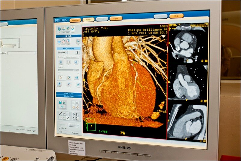 Мскт ангиография. Мультиспиральная компьютерная томография коронарография. Мультиспиральная компьютерная томография сердца. Мультиспиральная рентгеновская компьютерная томография(МСКТ) сердца.