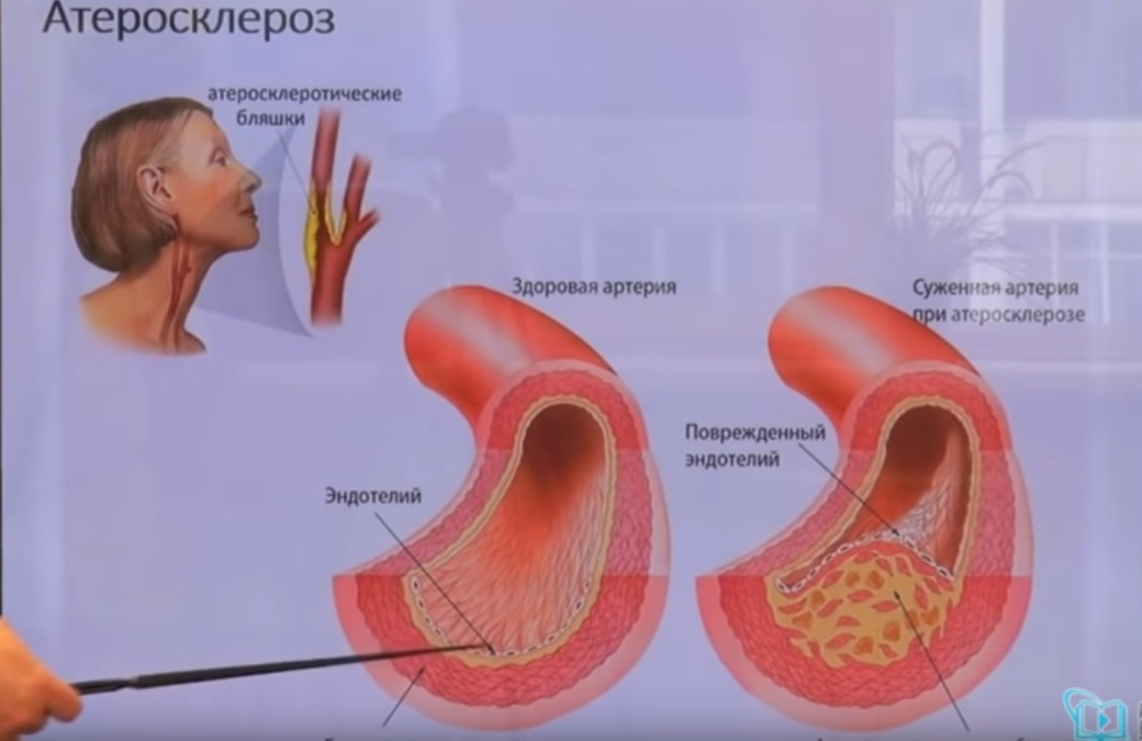 Атеросклеротическая бляшка.
