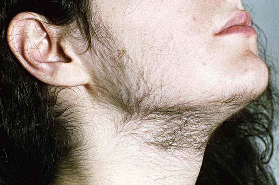 Проявления гирсутизма у женщин. Источник: Яндекс.Картинки